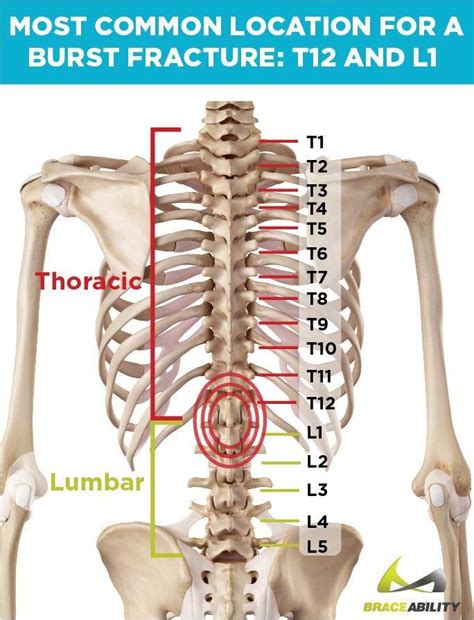 What Does it Mean If I’ve Been Diagnosed with a T12 or L1 Vertebral Burst Fracture?