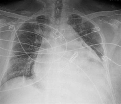 Devices in Radiology | Heart