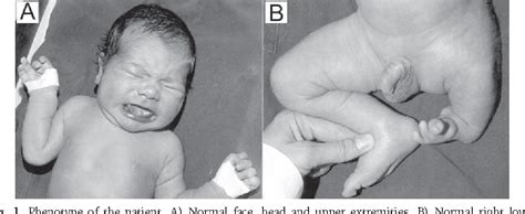 Figure 1 from A case with proximal femoral focal deficiency (PFFD) and ...