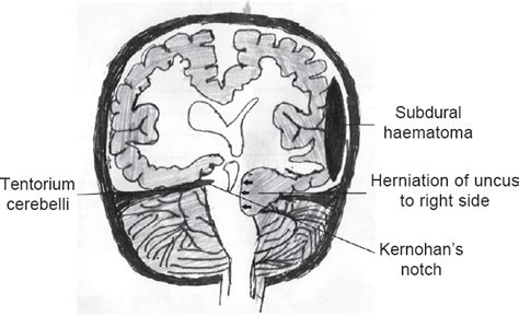 Kernohan–Woltman phenomenon: A false localizing sign - The National Medical Journal of India