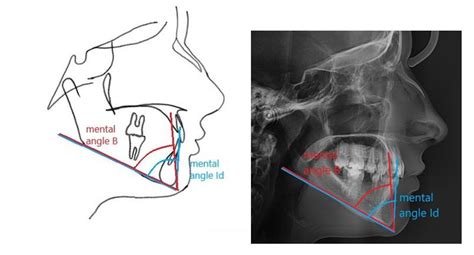 Angular measurements of the mandible used in the study. (a)shows... | Download Scientific Diagram