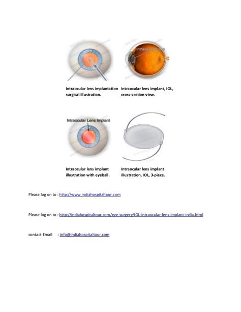 Iol intra-ocular lens implant in india at mumbai and delhi at low cost