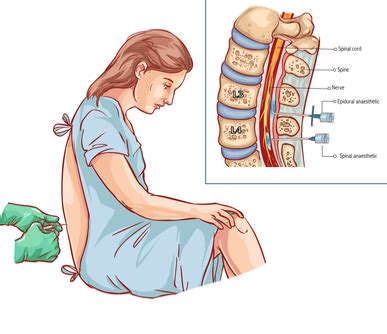 Epidural Steroid Injections - Spine Institute of Arizona