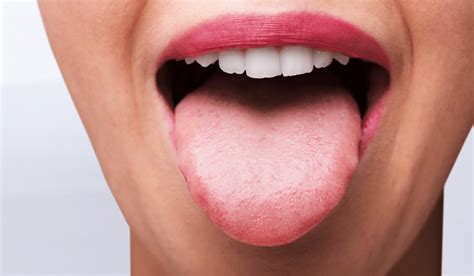 Proper Tongue Posture: Why Does It Matter?