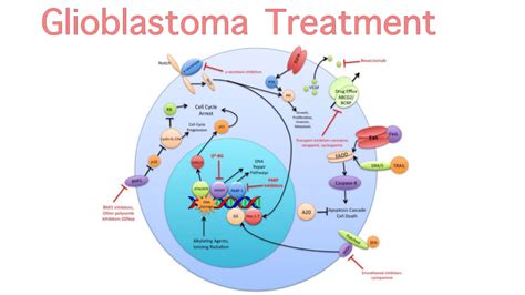 Glioblastoma Treatment - IMC Grupo