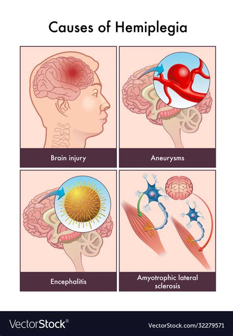 Causes hemiplegia Royalty Free Vector Image - VectorStock