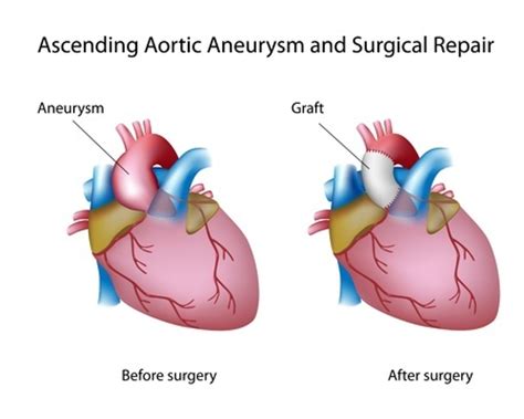 Thoracic Aortic Aneurysm - Treatment in Israel | D.R.A Medical