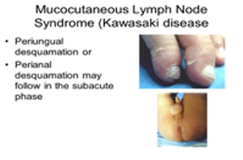 Mucocutaneous Lymph Node Syndrome