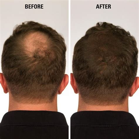 Hair Fibers For Thinning Hair | Hair Thickening Fibers - Infinity