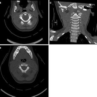 X-ray demonstrating C2 on C3 pseudosubluxation | Download Scientific Diagram