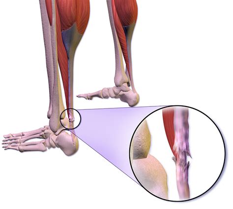 Tearing Your Achilles Tendon