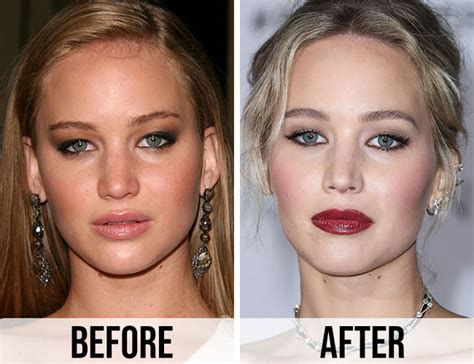 Jennifer Lawrence Nose Job Before And After