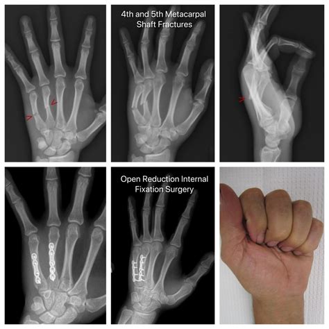 ORIF Surgery of 4th and 5th Metacarpal Fractures - John Erickson, MD