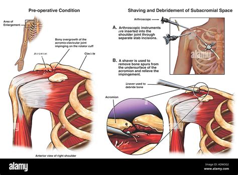 Shoulder Impingement Syndrome with Arthroscopic Surgery Stock Photo ...