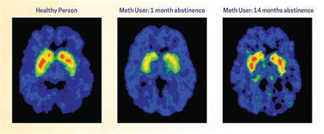 Treatment and Recovery | National Institute on Drug Abuse (NIDA)