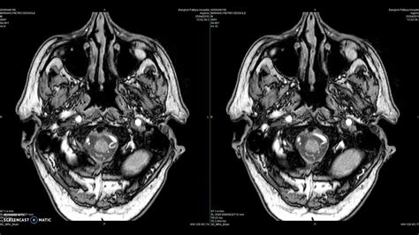 MRI Brain with MRA - YouTube
