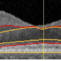 Segmentation of some retinal layers in OCT images. | Download Scientific Diagram