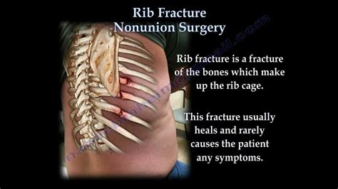 Rib Fracture Nonunion Surgery - Everything You Need To Know - Dr. Nabil Ebraheim - YouTube