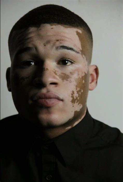 Male Model With Vitiligo - template