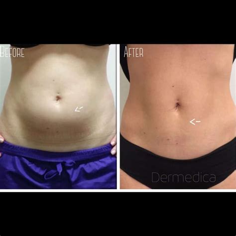 Coolsculpting for Abdomen | Before and After Photos | Dermedica