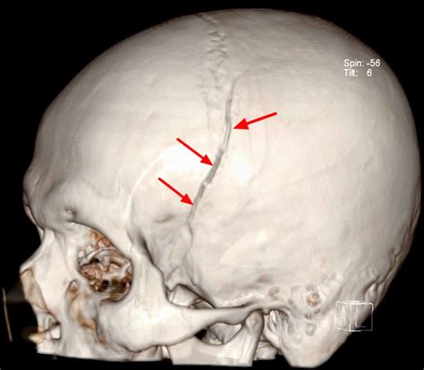 Epidural hematoma causes, signs, symptoms, diagnosis & treatment