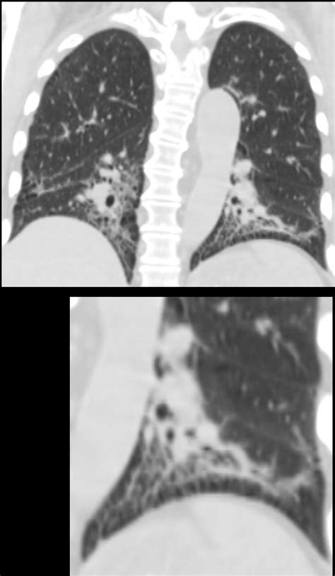 Faces of Centrilobular Nodules – Size | Lungs