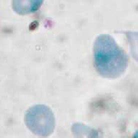 Peripheral blood smear showing teardrop cell, schistocytes,... | Download Scientific Diagram