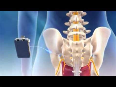 Overview of Interstim procedure - YouTube