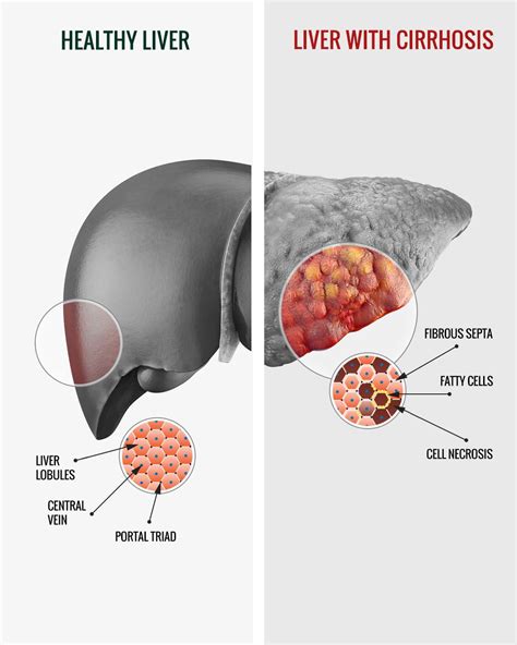 Causes, symptoms and prevention methods for hepatic steatosis - ProHumano+ Health Support