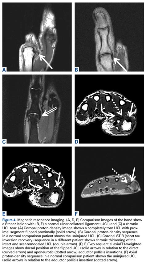 Multimodality Approach to a Stener Lesion: Radiographic, Ultrasound ...