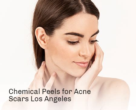 Chemical Peels for Acne Scars Los Angeles