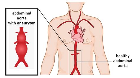 Abdominal Aortic Aneurysm: Causes, Treatment and Prevention