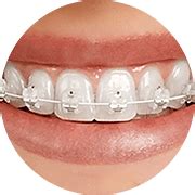 transparent-braces - Aspects Dental & Referral - Milton Keynes