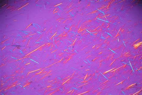 Gout Vs Pseudogout Crystals