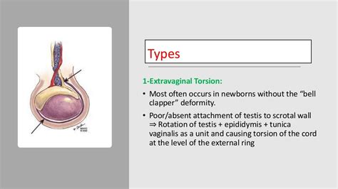 Testicular Torsion - Pediatrics Surgery