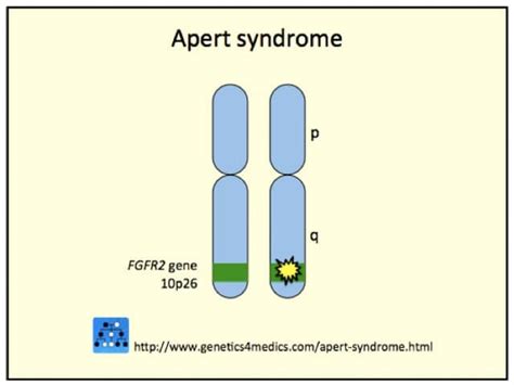 DermNet® - Crouzon syndrome