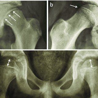 (a) Severe, acute on chronic SCFE in a 15-year-old male patient with... | Download Scientific ...