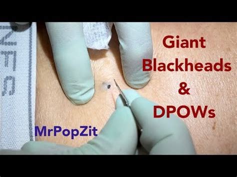 Blackheads array from Mr. Popzit : popping