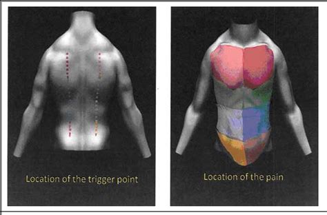 Figure 2 from Iliocostalis Thoracis-Lumborum Myofascial Pain: Reviewing a Subgroup of a ...