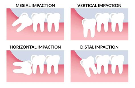 Wisdom Tooth Extraction/Removal in Bangkok, Thailand