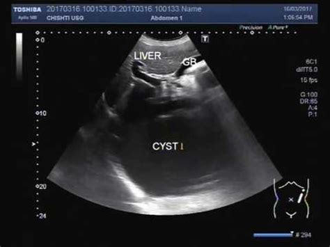 Ultrasound Video showing a large cyst in Liver. - YouTube