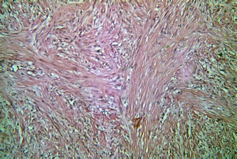 Infantile Myofibromatosis(myofibroma, congenital generalized myofibromatosis) - Dermatology Advisor