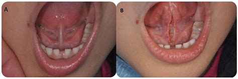 Children | Free Full-Text | Atmospheric Plasma Lingual Frenectomy ...