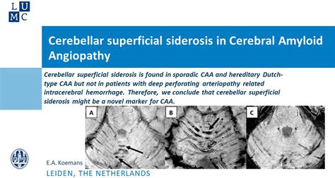 Cerebellar Superficial Siderosis in Cerebral Amyloid Angiopathy | Stroke