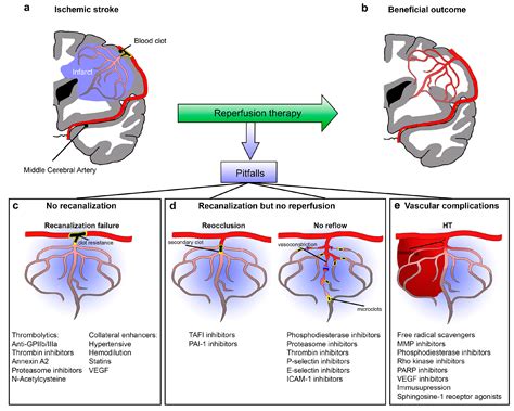 IJMS | Free Full-Text | Improving Cerebral Blood Flow after Arterial Recanalization: A Novel ...