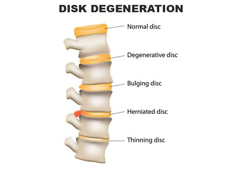 Herniated Disc C4/C5 and C5/C6 Injuries - Fort Worth, TX - Stephens Law ...