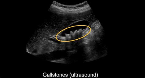 Abdominal CT: cholecystitis • LITFL • Radiology Library