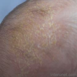 What is cradle cap - baby head skin rash | interunet