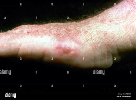 Mild Dermatitis Herpetiformis On Hands