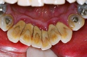 12 Calculus on Teeth ideas | dental, dental health, periodontitis